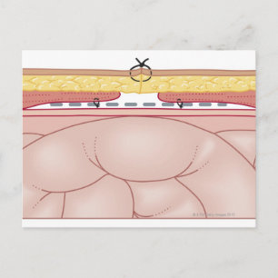 Illustration of a Hernia Postcard