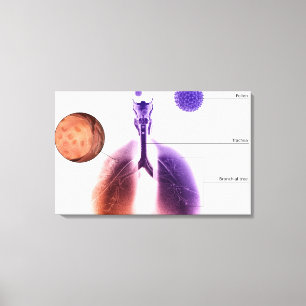 Illustration of an asthma attack from pollen canvas print