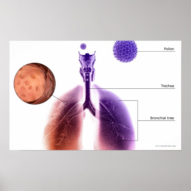 Illustration of an asthma attack from pollen poster (Front)