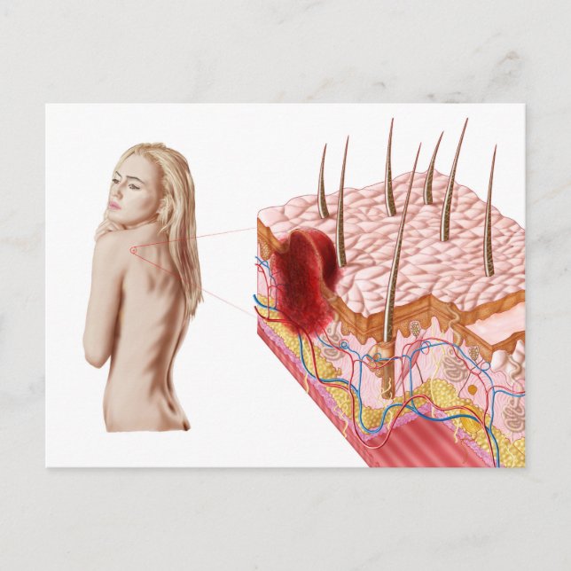 Illustration Of An Atypical Growth On The Skin Postcard (Front)