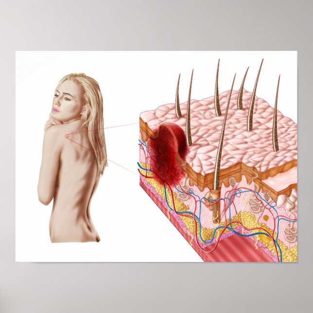 Illustration Of An Atypical Growth On The Skin Poster (Front)