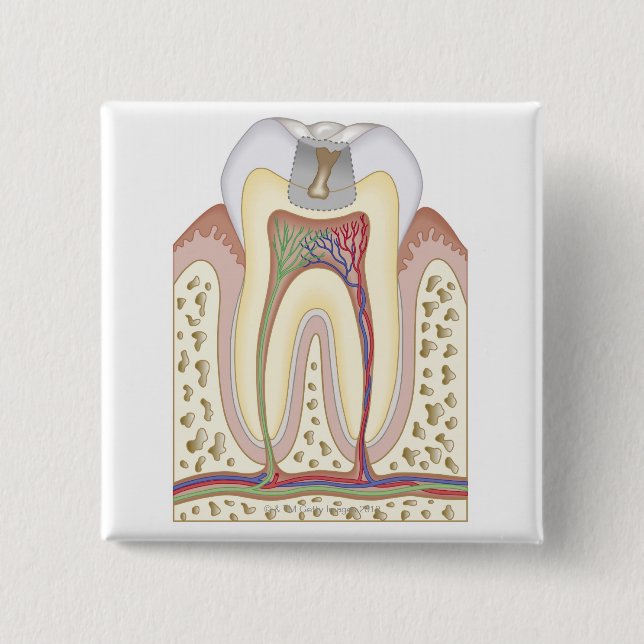 Illustration of Tooth Decay 2 Inch Square Button (Front)