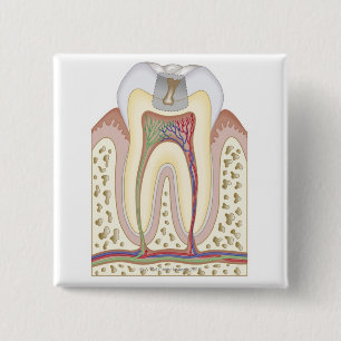 Illustration of Tooth Decay 2 Inch Square Button