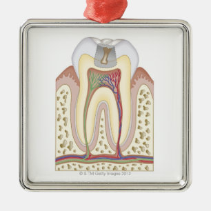 Illustration of Tooth Decay Metal Ornament