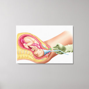 Illustration Showing Delivery Of Fetus 1 Canvas Print