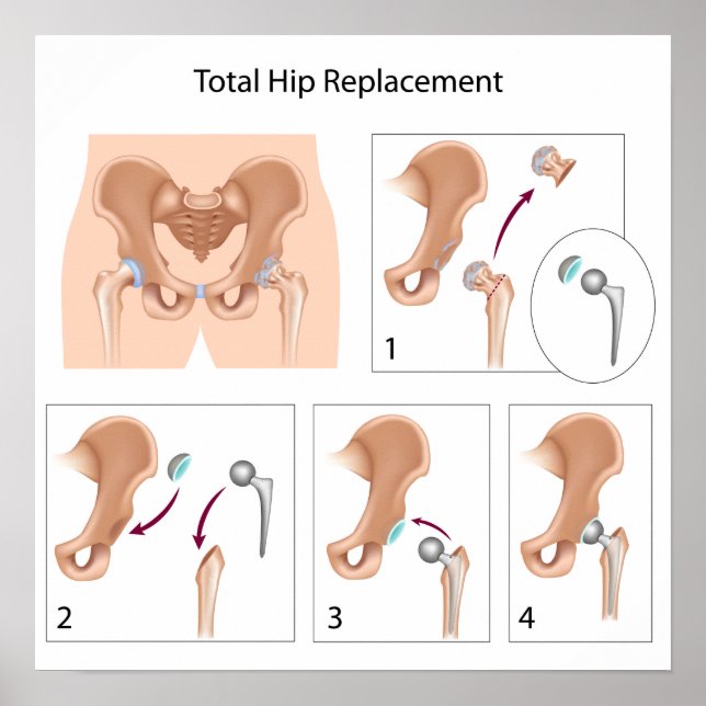 Impression de chirurgie de remplacement de la hanc (Devant)