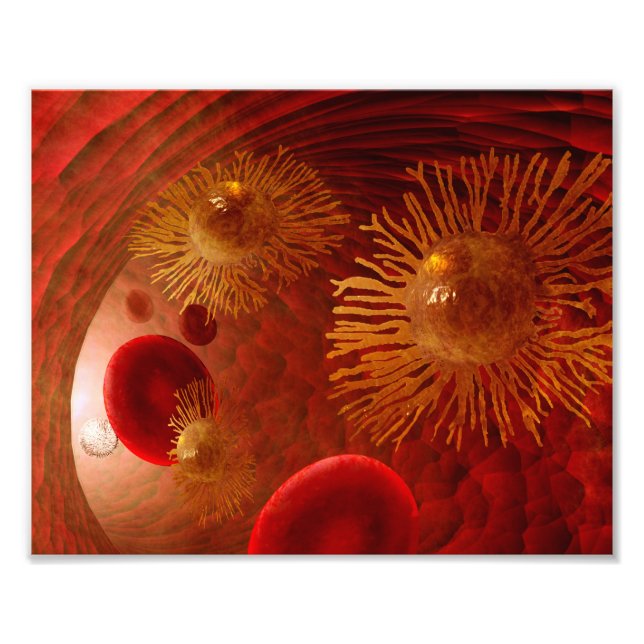 Impression Photo Affiche de métastase du cancer (Devant)