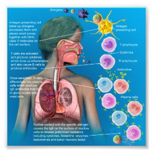 Impression Photo Allergies : affiche de réponse inflammatoire IgE