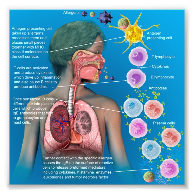 Impression Photo Allergies : affiche de réponse inflammatoire IgE (Devant)