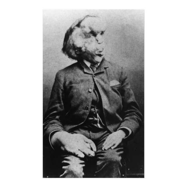 Impression Photo Joseph "John" Merrick L'homme éléphant de 1889 (Devant)