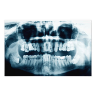 Impression Photo Rayon X des dents