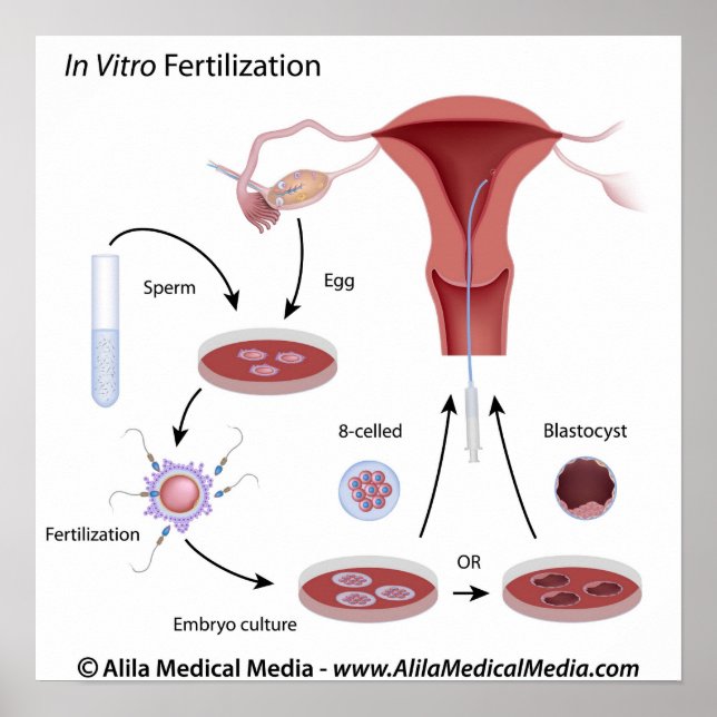 In Vitro Fertilization (IVF) procedure labelled. Poster (Front)