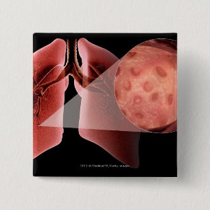 Inflammed airway during an asthma attack 2 inch square button