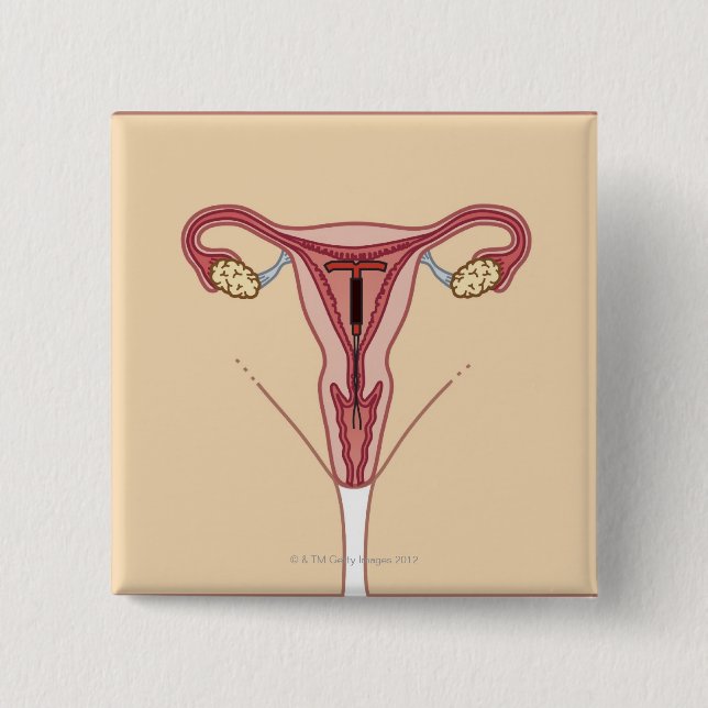 Intrauterine Device 2 Inch Square Button (Front)