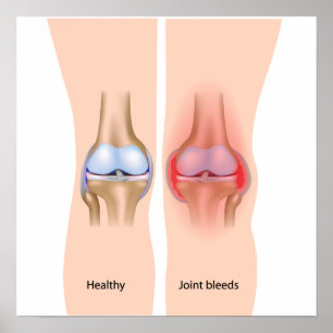 Joint bleeds in hemophilia Poster