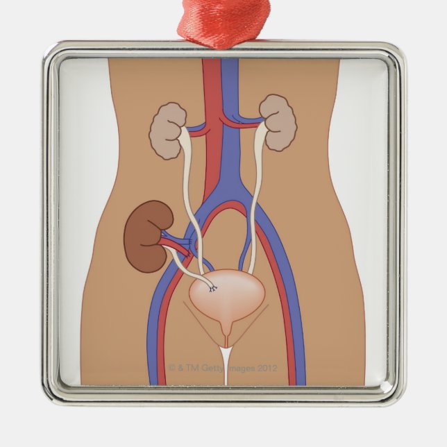 Kidney Transplant Metal Ornament (Front)