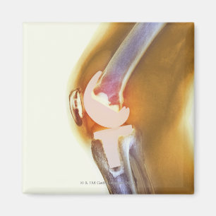 Knee replacement. Coloured X-ray of a total knee Magnet