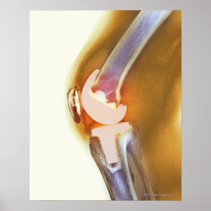 Knee replacement. Coloured X-ray of a total knee Poster