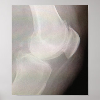 Knee X-ray Poster