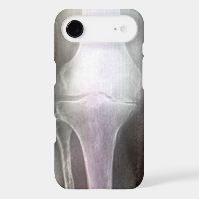KNEE XRAY IPHONE COVER (Back)