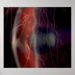 Lightning Over a Torn Cornea Poster