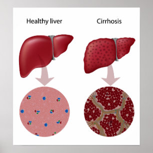 Liver disease Cirrhosis Poster