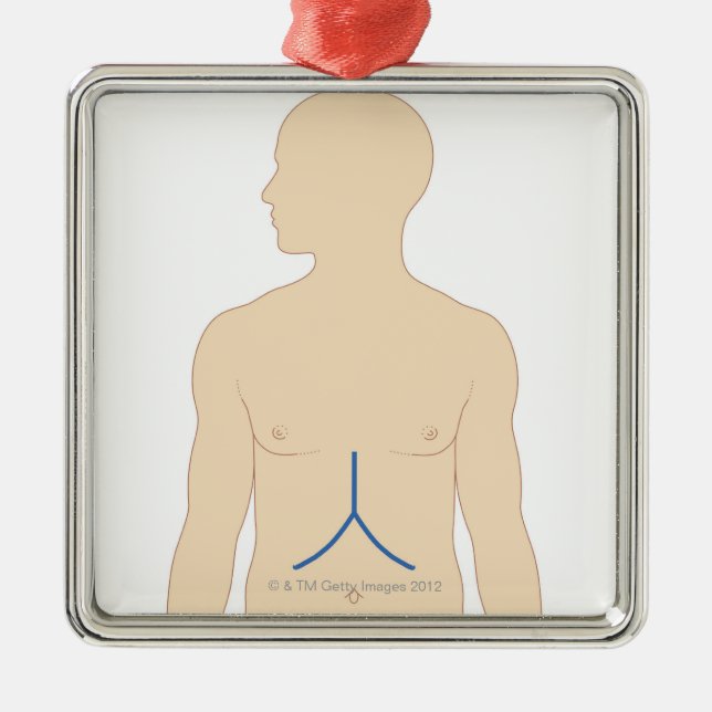 Liver Transplant Metal Ornament (Front)