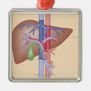 Liver Transplant Procedure Metal Ornament