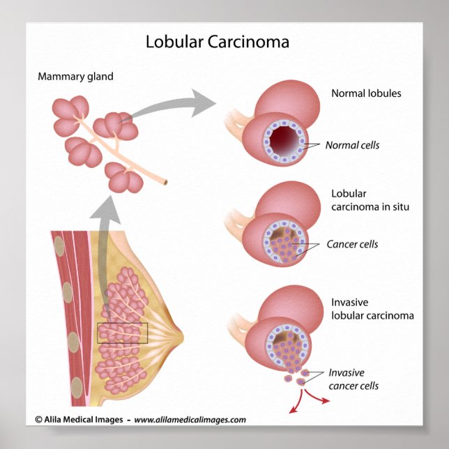 Lobular breast cancer, labelled diagram. poster (Front)