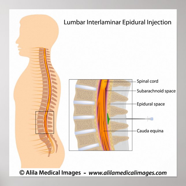 Lumbar epidural injection, labelled diagram. poster (Front)