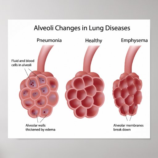 lung diseases Poster | Zazzle