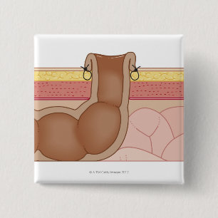 Macaron Carré 5 Cm Colostomie permanente