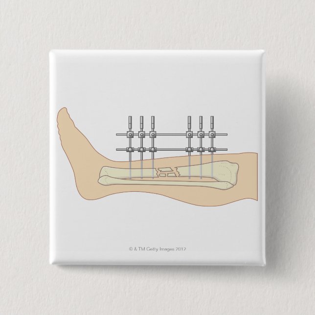 Macaron Carré 5 Cm Fixateur externe (Devant)