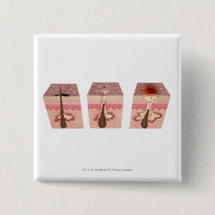 Macaron Carré 5 Cm Vue de ce qui cause l'acné