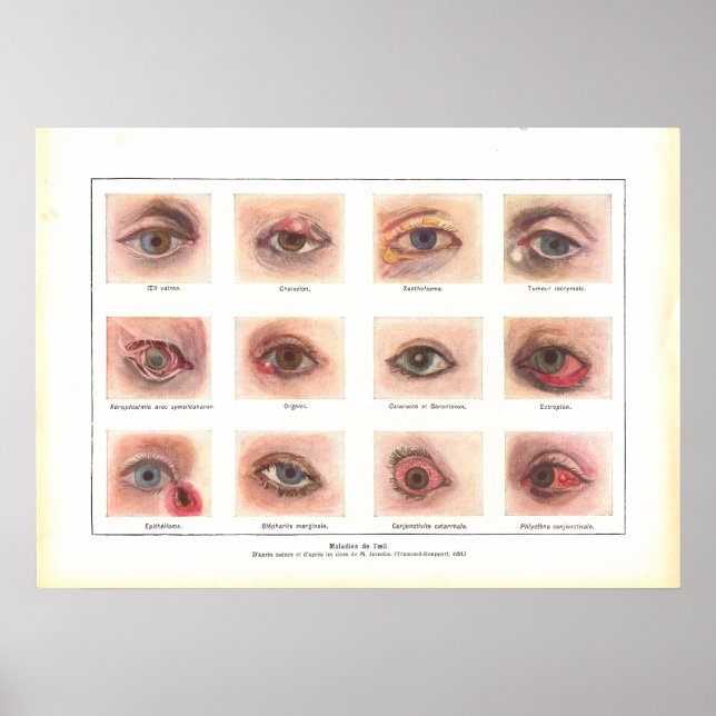 Maladies de l'oeil Anatomie Poster Français (Devant)