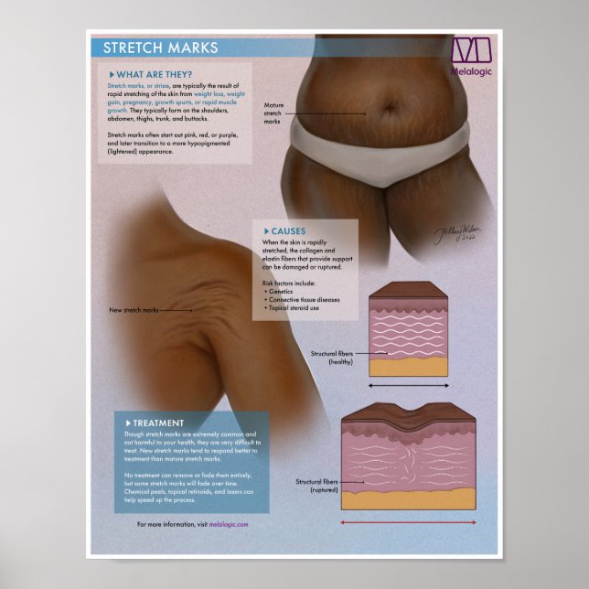 Marques d'étirement Melalogique Poster Médicale (Devant)