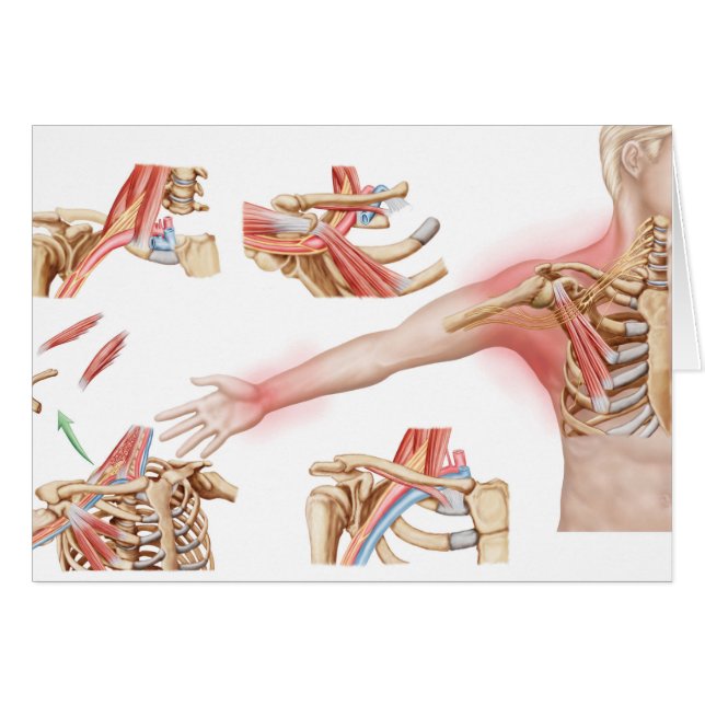 Medical Illustration Detailing Thoracic Outlet (Front Horizontal)