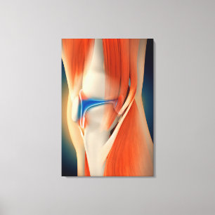 Medical Illustration: Inflammation In Knee Canvas Print