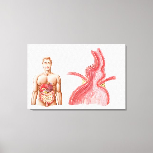 Medical Ilustration Of A Hiatal Hernia In The Canvas Print (Front)