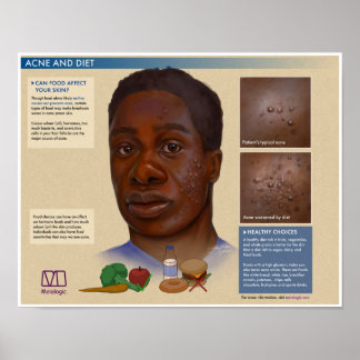 Melalogic Acne and Diet Medical Poster