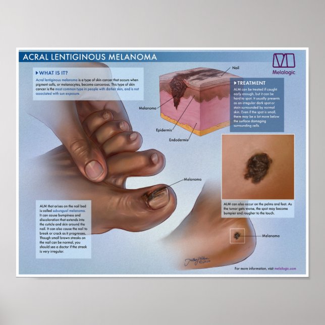 Melalogic Acral Lentiginous Melanoma Medical Poste Poster (Front)