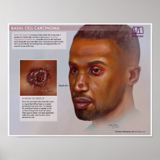 Melalogic Basal Cell Carcinoma Medical Poster