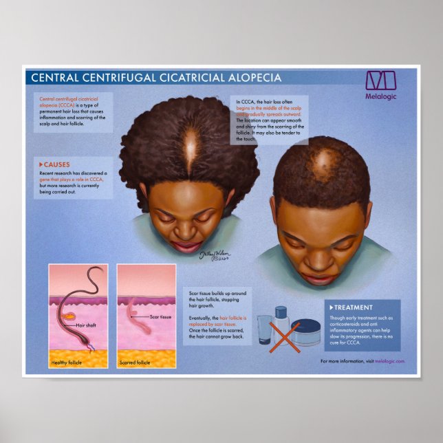 Melalogic Central Centrifugal Cicatricial Alopecia Poster (Front)