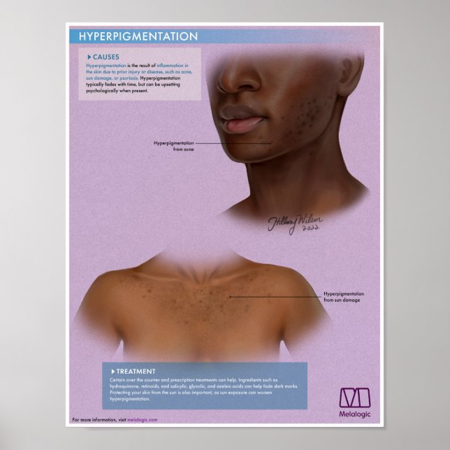 Melalogic Hyperpigmentation Medical Poster (Front)