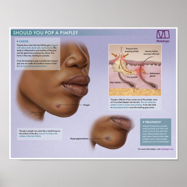 Melalogic Popping Pimples Medical Poster (Front)