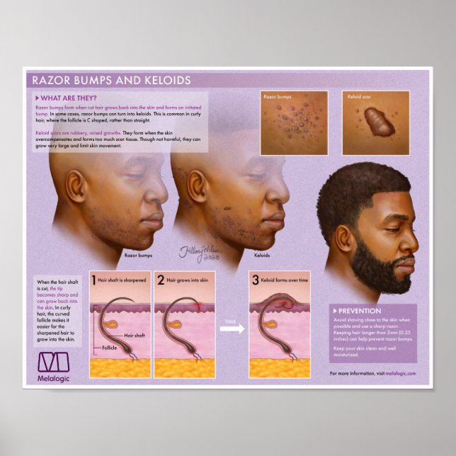Melalogic Razor Bumps and Keloids Medical Poster (Front)