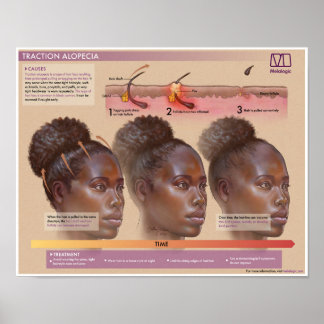 Melalogic Traction Alopecia Poster Médicale