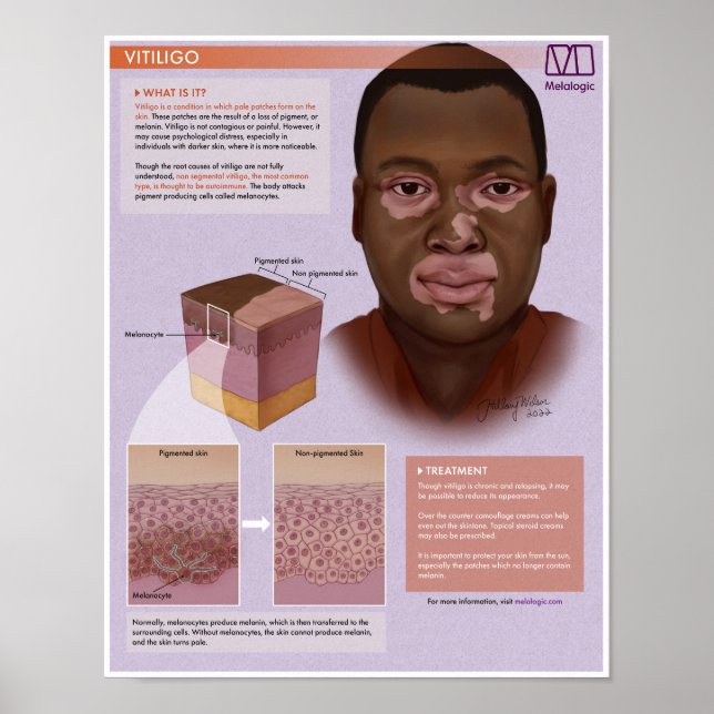 Melalogic Vitiligo Medical Poster (Front)