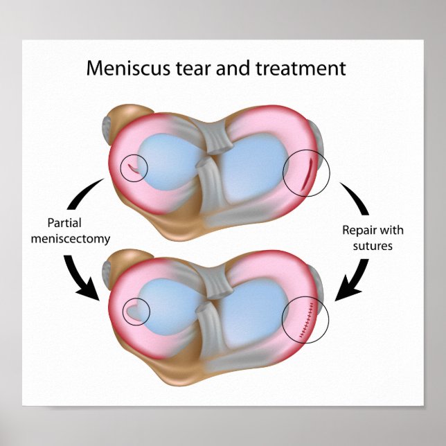 Meniscus larme et chirurgie Poster (Devant)