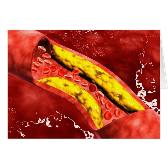 Microscopic View Of Fat Plaque Inside The Artery (Front Horizontal)